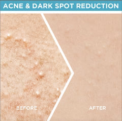 Garnier SkinActive Fast Clear Booster acne-prone skin serum